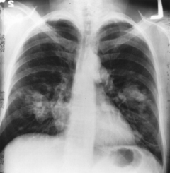 Lung x-ray